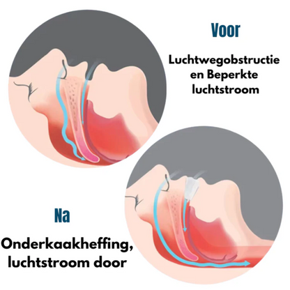 SnoreXpert Anti-Snurk Beugels